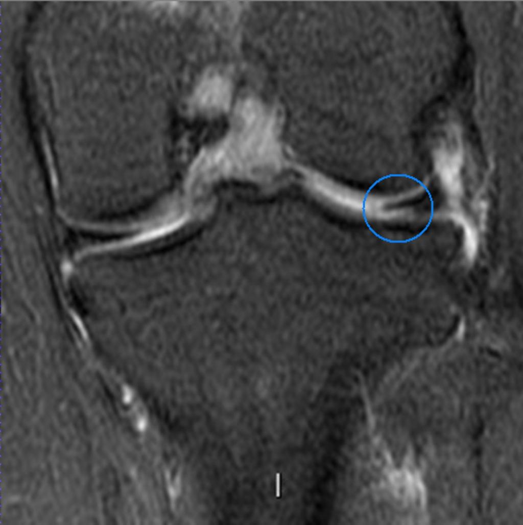 Fig.: Displaced inferior flap tear on the LM (coronal