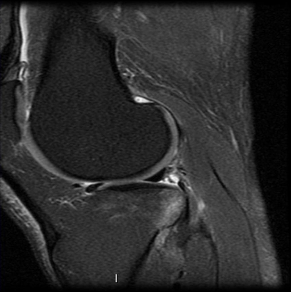 Fig.: Inferiorly displaced flap tear on the posterior horn of the LM