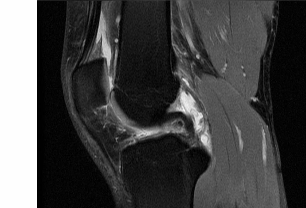 Fig.: Posterior joint capsule lesion.