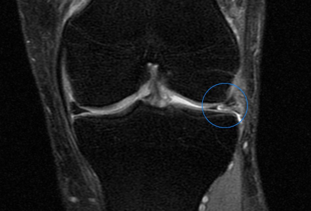 Fig.: This is the patient refered to in the last image. Here is shown the tear of the anterior horn of the lateral mensicus (coronal plane).