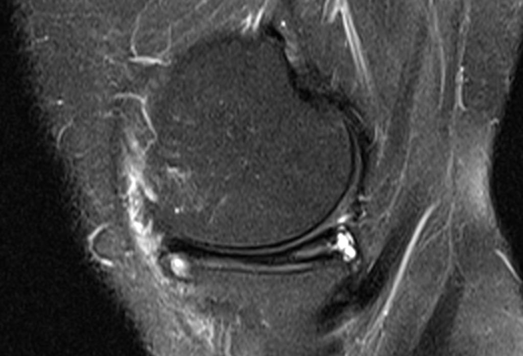 Meniscal cysts occur more frequently in the medial compartment, twice as common as LM cysts. The most widely accepted cause of meniscal cysts is extension of fluid through a meniscal tear.