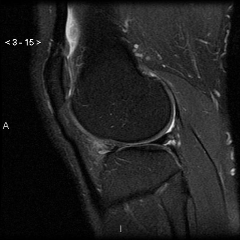 Fig.: Discoid lateral meniscus with tear and degeneration of the