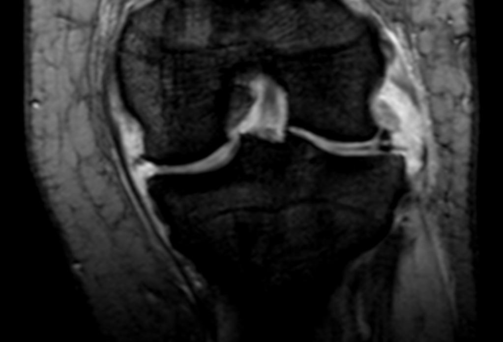 Fig.: Extrusion and fragmentation of the medial meniscus - severe degenerative aspects.