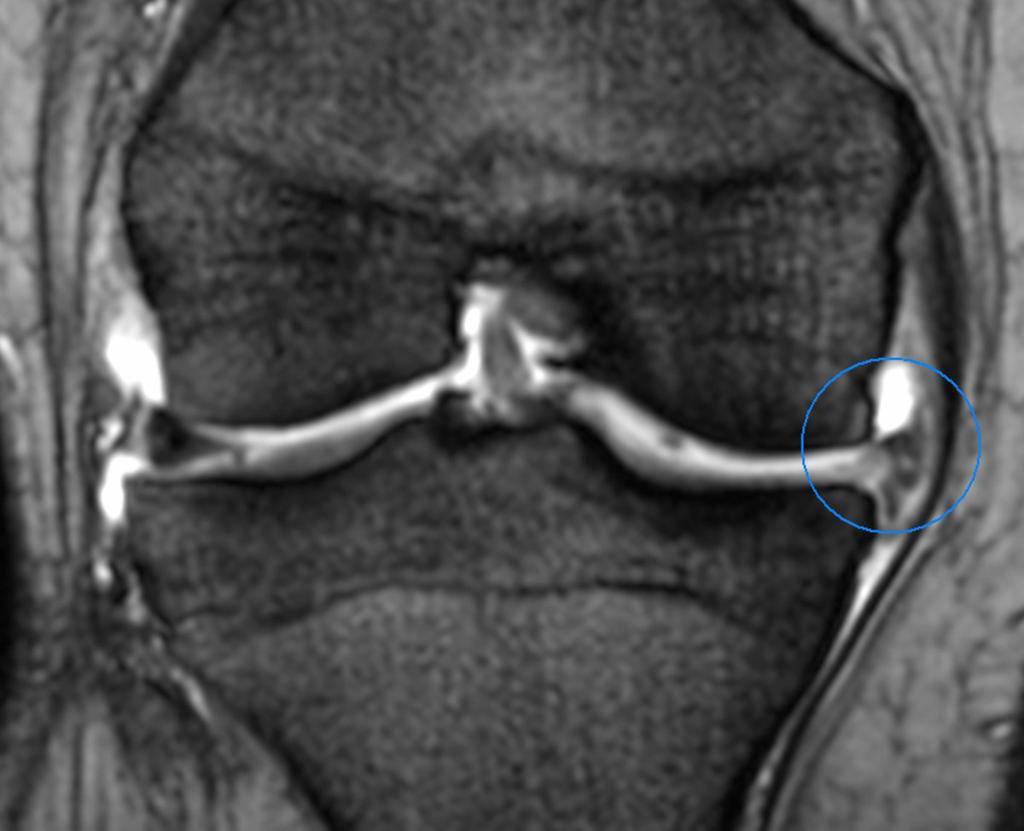 Fig.: Extrusion of the medial meniscus with an associated meniscal