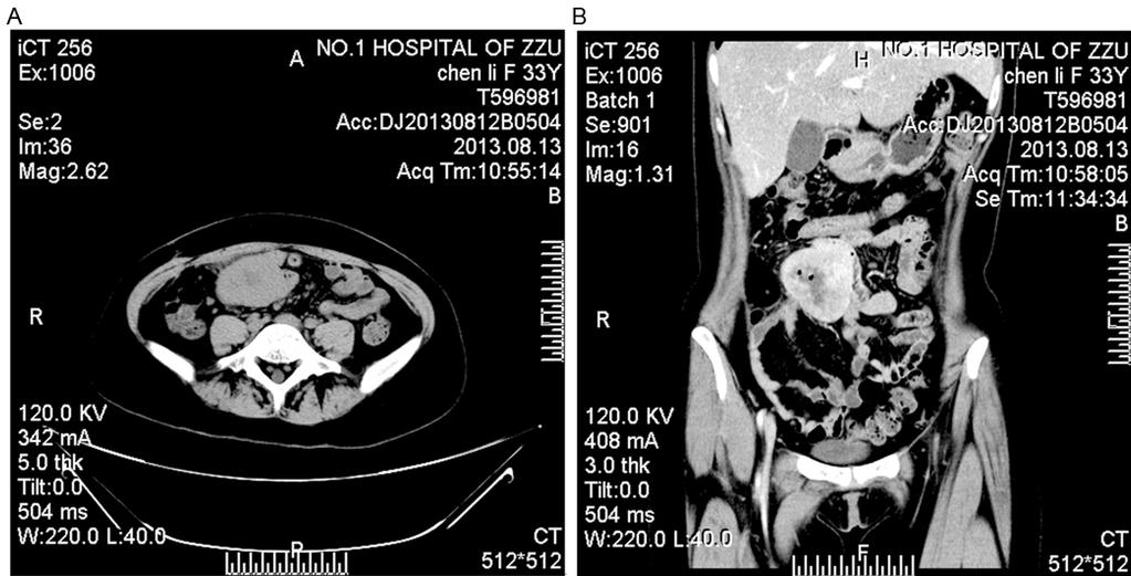Figure 1. A, B. Axial and enhanced coronal CT revealed a lump with relative demarcation, communicating with the intestinal lumen. ment (Ventana Systems, Tucson AZ).