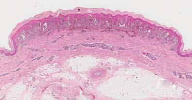 92 Verardino GC, Rochael MC relation to the epidermis, confluence of nests, clefts between the nests of melanocytes in the epidermis and the keratinocytes, pagetoid spread, maturation of melanocytes,