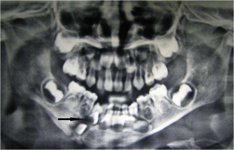 3 Journal of Research and Practice in Dentistry _ Figure 2: Pre extraction radiograph Osteogenesis and union was the best radiographic criterion for evaluating followup radiographs.