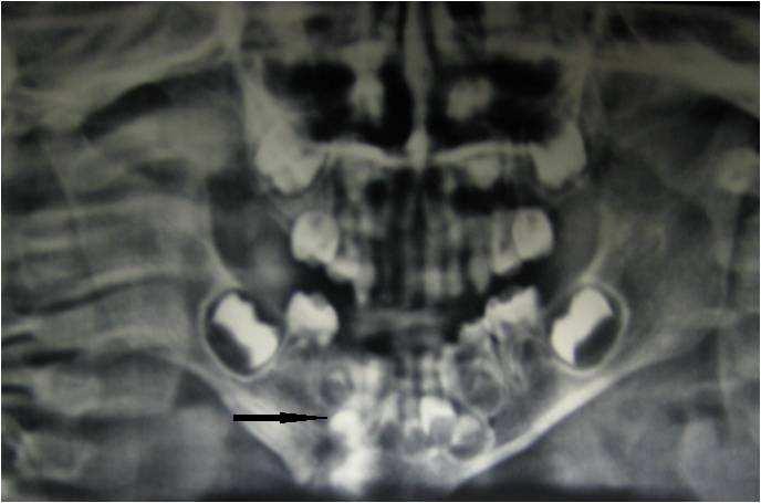 Journal of Research and Practice in Dentistry 4 _ Figure 3: Radiograph after 3 months Discussion The incidence of abnormalities in teeth present in fracture line after dental and maxillofacial