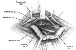 Bassini Repair : The conjoined tendon of the transversus abdominis and the internal oblique muscles is sutured to the inguinal