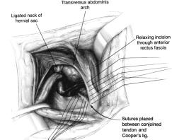 hernias, recurrent hernias of the groin, and femoral hernias The conjoined tendon is sutured to Cooper's ligament from the pubic