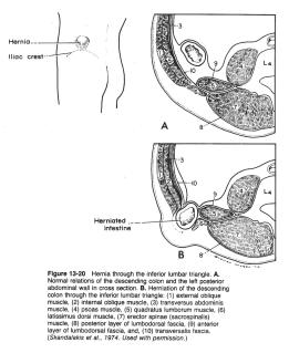 (5) Obturator Hernia The patient may present with evidence of compression of the obturator nerve, resulting in pain in the medial aspect of the thigh.
