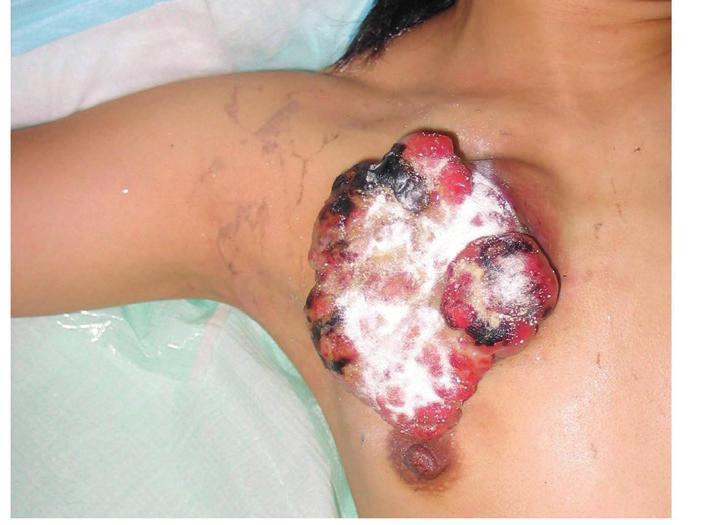 A forequarter amputation was performed with in continuity excision of the local recurrent tumour.