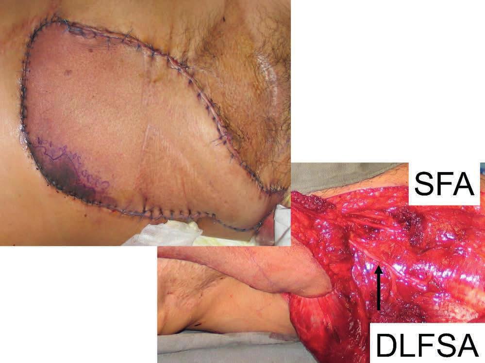 The donor site was reduced in size by inverting the skin margins and the muscle was grafted.