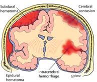 Brain Brainstem Consists of: Medulla Pons Midbrain Contains centers that control: Involuntary respiration