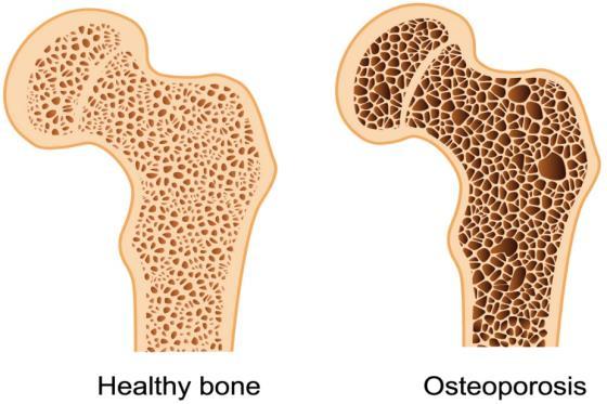 The History of Osteoporosis Test 1990/ 1993 First/ Second International Symposia on Osteoporosis 1995 Fosamax approved by the FDA 1994 It s official: Osteoporosis is officially classified a disease