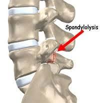 Spondylolysis Pars Interarticularis Injury Cause of up to 47% LBP in young If ossification incomplete of superior