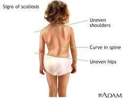 Scoliosis SHOULD NOT CAUSE BACK PAIN!