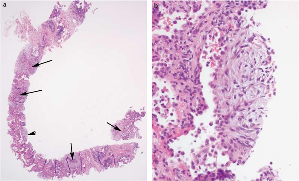 S54 Small biopsies of lung nodules Figure 11 Organizing pneumonia. (a) Core needle biopsy of a 2.5-cm nodule in a 51-year-old male smoker found to have multiple nodules in the right lower lobe.