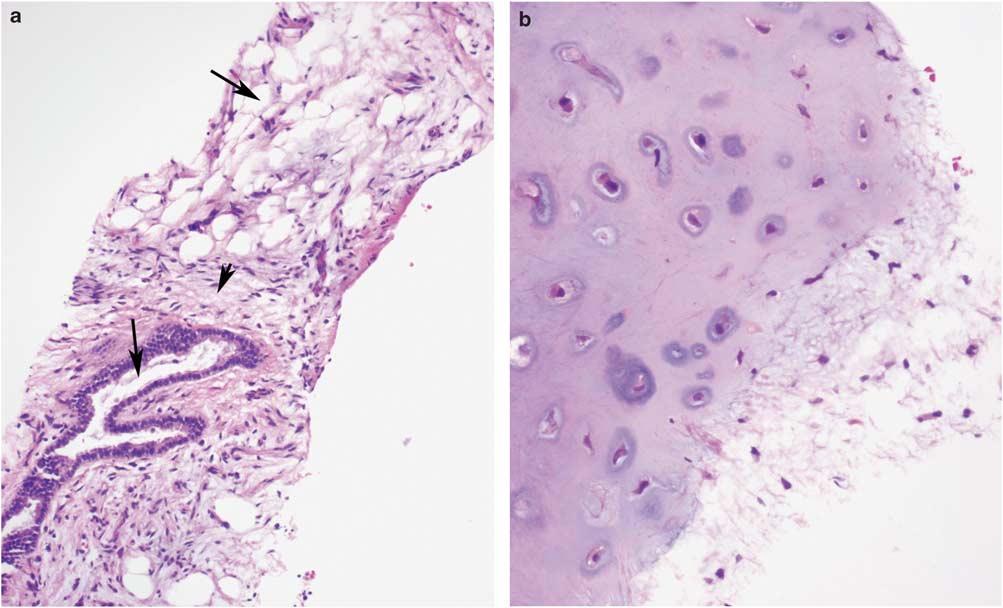 (b) High magnification of the fibroblast plug indicated by the arrowhead in panel a, showing fibroblasts within a pale-staining stroma. Figure 12 Chondroid hamartoma. Core needle biopsy of a 1.