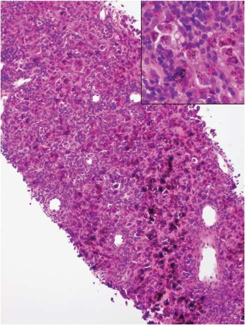 Small biopsies of lung nodules S55 Does immunohistochemistry exclude other primary or metastatic tumors from the differential diagnosis? No.