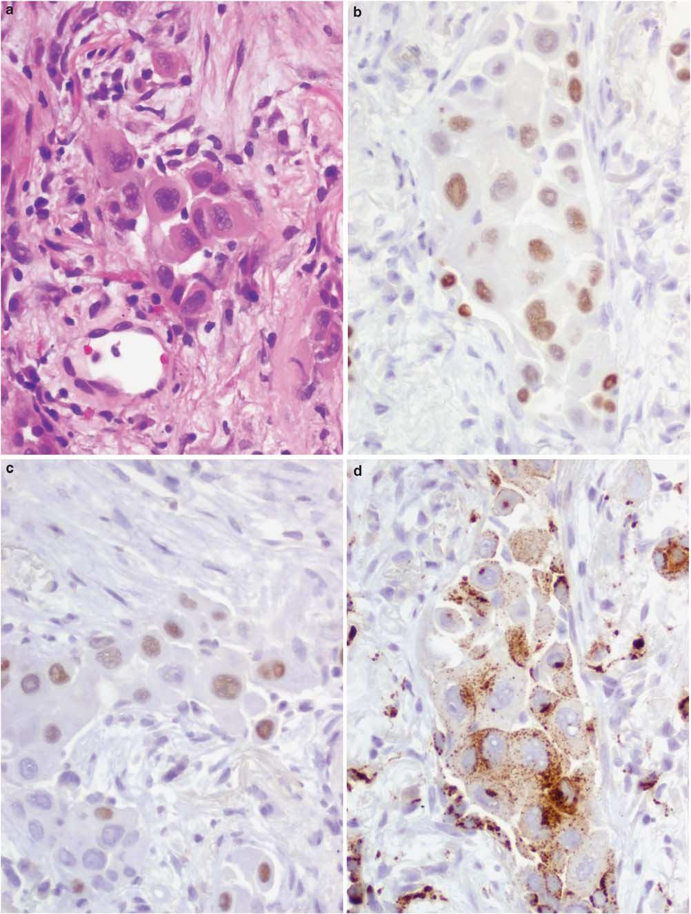 S50 Small biopsies of lung nodules Figure 7 p63 positivity in poorly differentiated adenocarcinoma. (a) Poorly differentiated non-small cell lung carcinoma in a small biopsy.