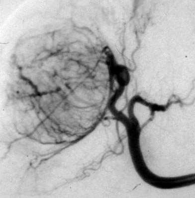 Rational of Transarterial Chemoembolization Dual blood supply with arterial vessels feeding