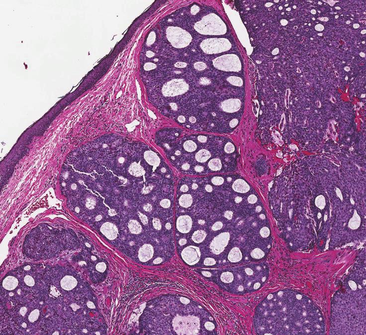 2 Figure 1: Low power H&E slide. The lobular architecture with cribriform pattern can be identified. There is no connection to the epidermis. Figure 3: High power H&E slide.