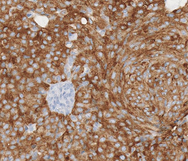Intracytoplasmic mucin could be identified, as it displayed a light blue hue on H&E stained slides, and extracellular mucin was also present throughout the tumor (Figure 3).