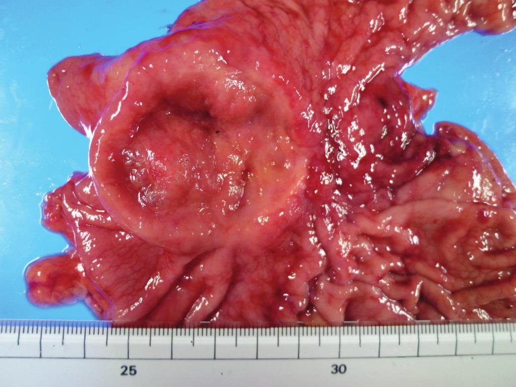 lymph node dissection and Billroth I