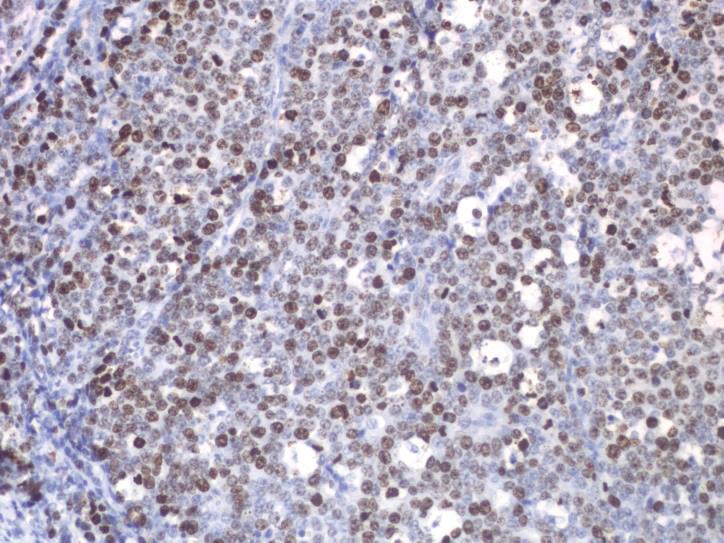 codon 179 of exon 5 in endocrine cells. (4/38) of Stage IIIB.