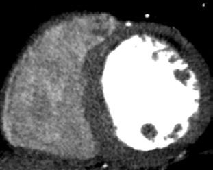 Description Myocardial CT perfusion imaging is a new diagnostic test for patients with suspicion of coronary artery disease (CAD).