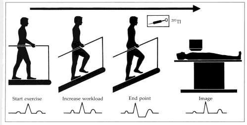 Exercise stressing in myocardial perfusion SPECT ASNC Imaging Guidelines 2008 & 2009 on stress protocols and tracers All exercise tests should