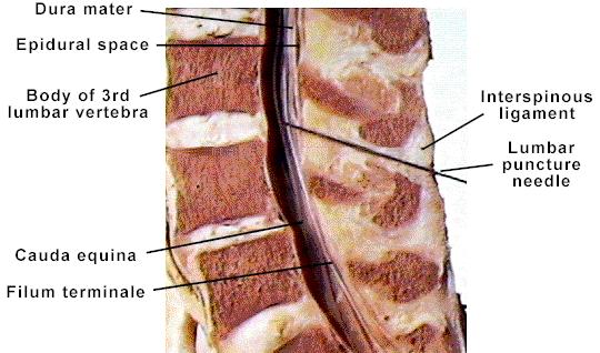 L3 Lumbar Puncture (= Spinal