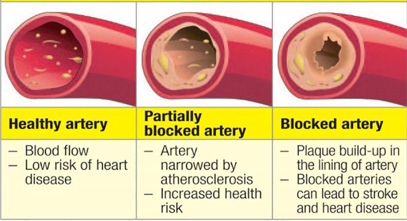 The diseased artery Healthy arteries are like soft, clean, rubber tubes with flexible sides Diseased arteries are stiff, thick, and clogged with