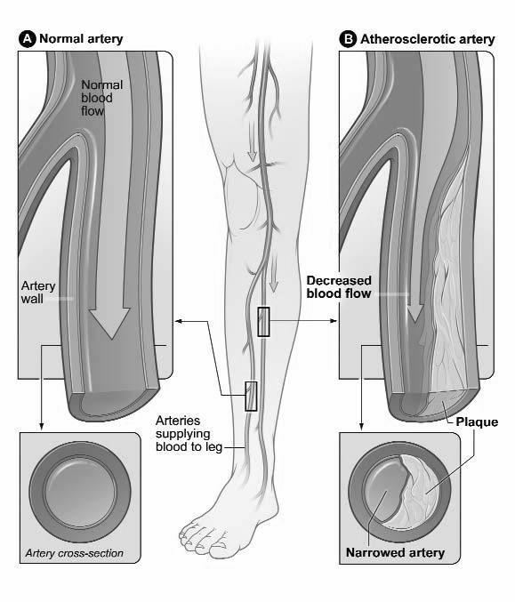 What is P.A.D.? Peripheral arterial disease also known as P.A.D. is a common, yet serious, disease.
