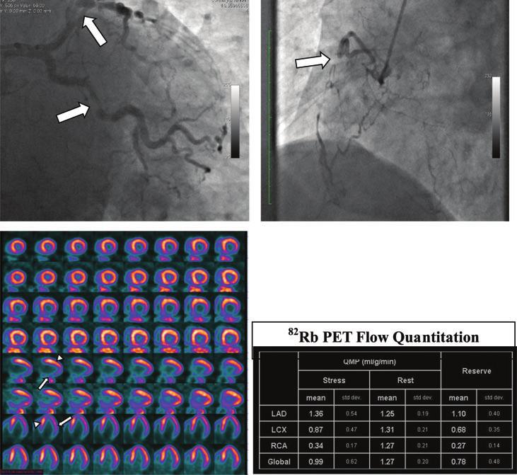 P. Arumugam et al. Fig. 5 A 57-year-old obese male presented with typical angina. 82 Rb images showed inducible ischaemia in the inferior and inferolateral myocardium (arrow).