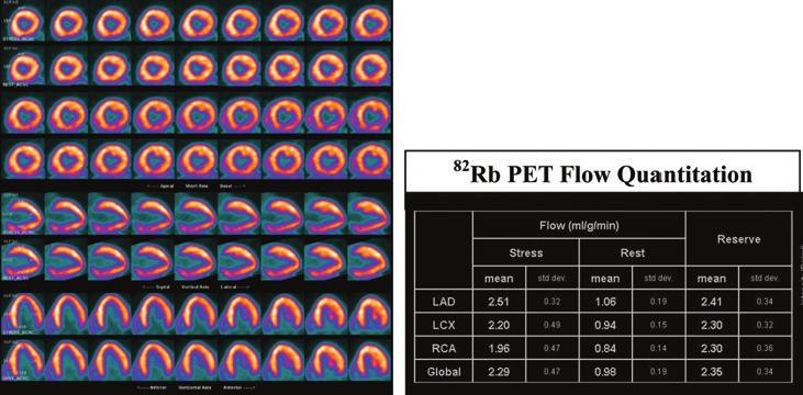 MPS using rubidium-82 PET Fig. 6 Dilated cardiomyopathy with globally reduced MPR.
