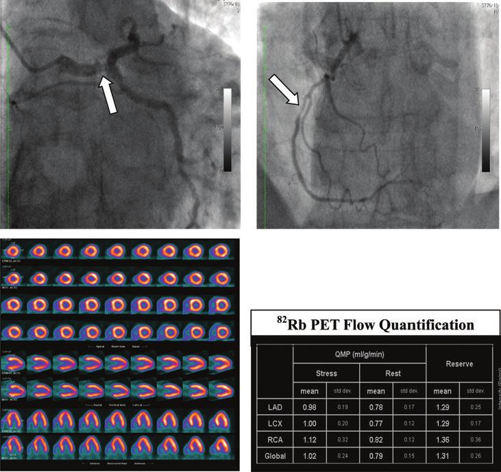 MPS using rubidium-82 PET Fig. 4 A 77-year-old male presented with NSTEMI (troponin rise but no localizing ECG changes). Coronary angiography showed proximal RCA disease and a probable LMS stenosis.