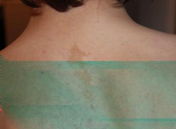 Figures Figure 1 Café au lait spots on the back of the patient.