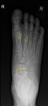 Figure 5 Conventional radiography of the right foot (AP projection) Conventional radiography of the right foot (AP projection)