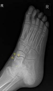 the metatarsals (thick open arrows).