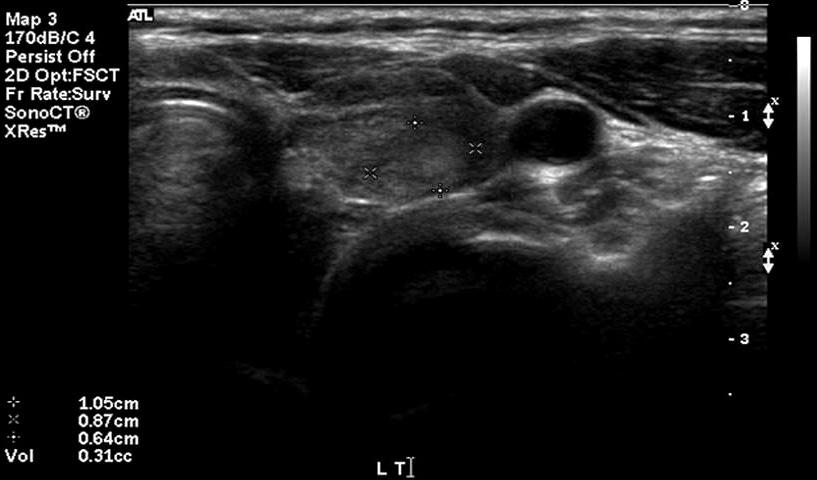 Because the patient had a history of hypothyroidism, we performed ultrasonography for further evaluation of the thyroid.