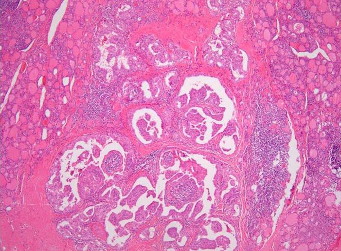 Although fine-needle aspiration revealed lymphocytic thyroiditis without evidence of malignancy, the thyroid ultrasonographic findings indicated a high possibility of thyroid malignancy; therefore,