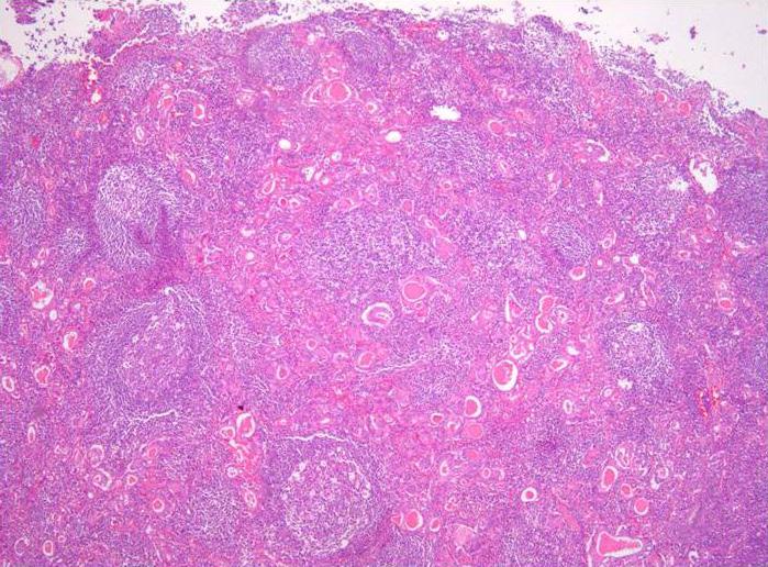 217 Perigastric Node Metastasis from Thyroid Cancer Fig. 4. Microscopic findings of gastric cancer.
