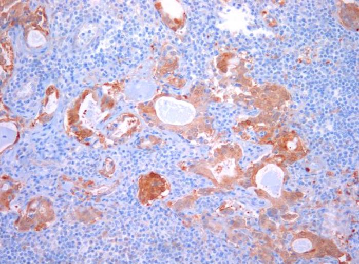 (A) Lymph nodes along the lesser curvature showing many glandular structures, suggesting gastric carcinoma metastasis (H&E, 40).