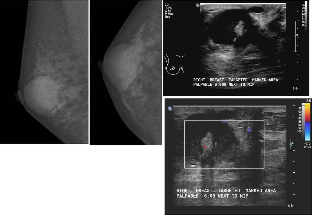 Fig. 3: A patient with a palpable central right breast lump. MLO and CC views show a well circumscribed density in the right retroareaolar region with few scattered coarse and punctate calcifications.