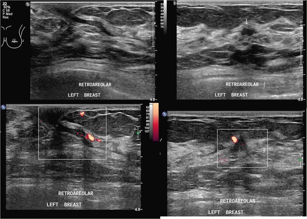 Fig. 4: A patient with persistent left nipple bloody discharge. Mammogram was unremarkable. US shows a dilated central duct with hypoechoic mildly vascular intraductal contents.