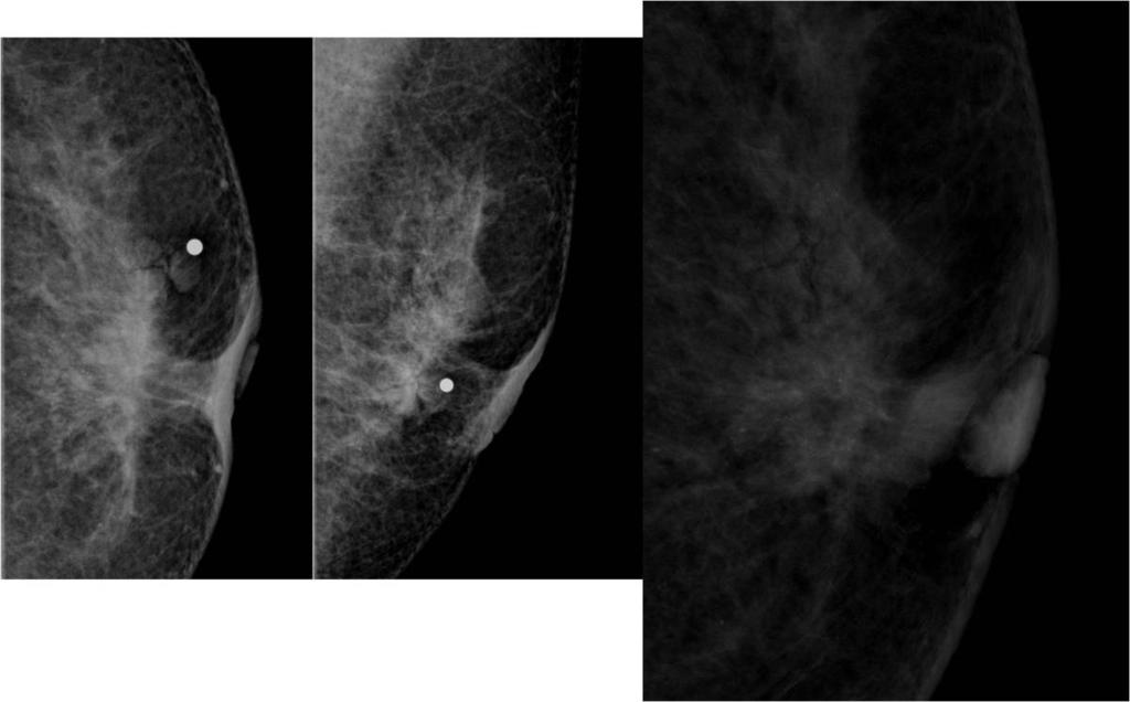 Fig. 8: Papillary DCIS : A patient with a large biopsy proven invasive ductal carcinoma right breast for contralateral breast imaging.