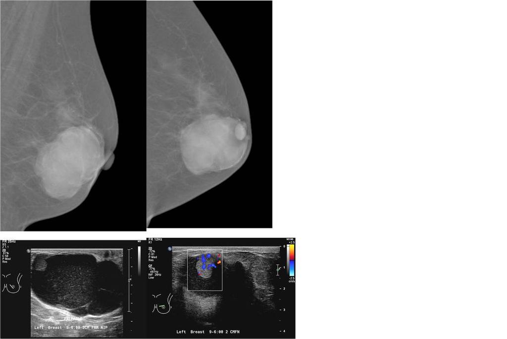 Fig. 9: Intracystic papillary carcinoma : A patient with a palpable left breast lump.