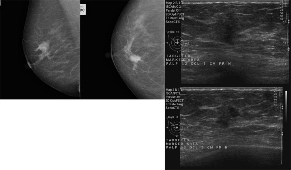 Fig. 10: A patient with left breast pain and bloody nipple discharge. US shows a slightly tall hypoechoic mildly lobulated lesion at 6:00 position, 3cm from the nipple.